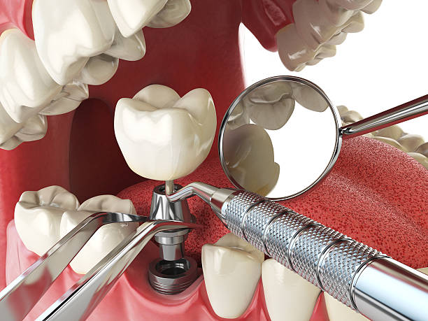 Best Emergency Dental Care for Broken or Chipped Teeth in New Baden, IL